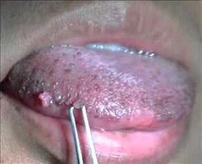 ľudský papilomavírus na jazyku