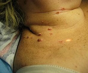 ľudský papilomavírus na krku