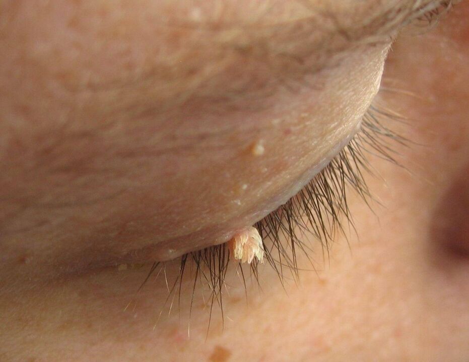 papilómy na očnom viečku