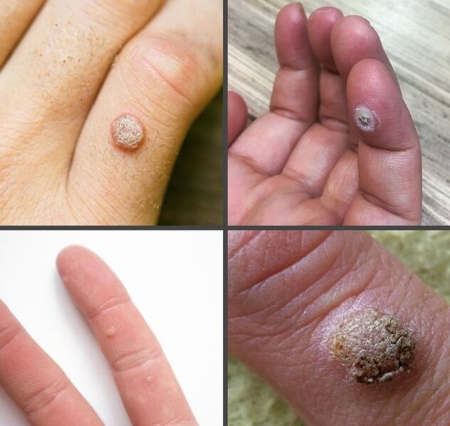 Bežné typy bradavíc na prstoch