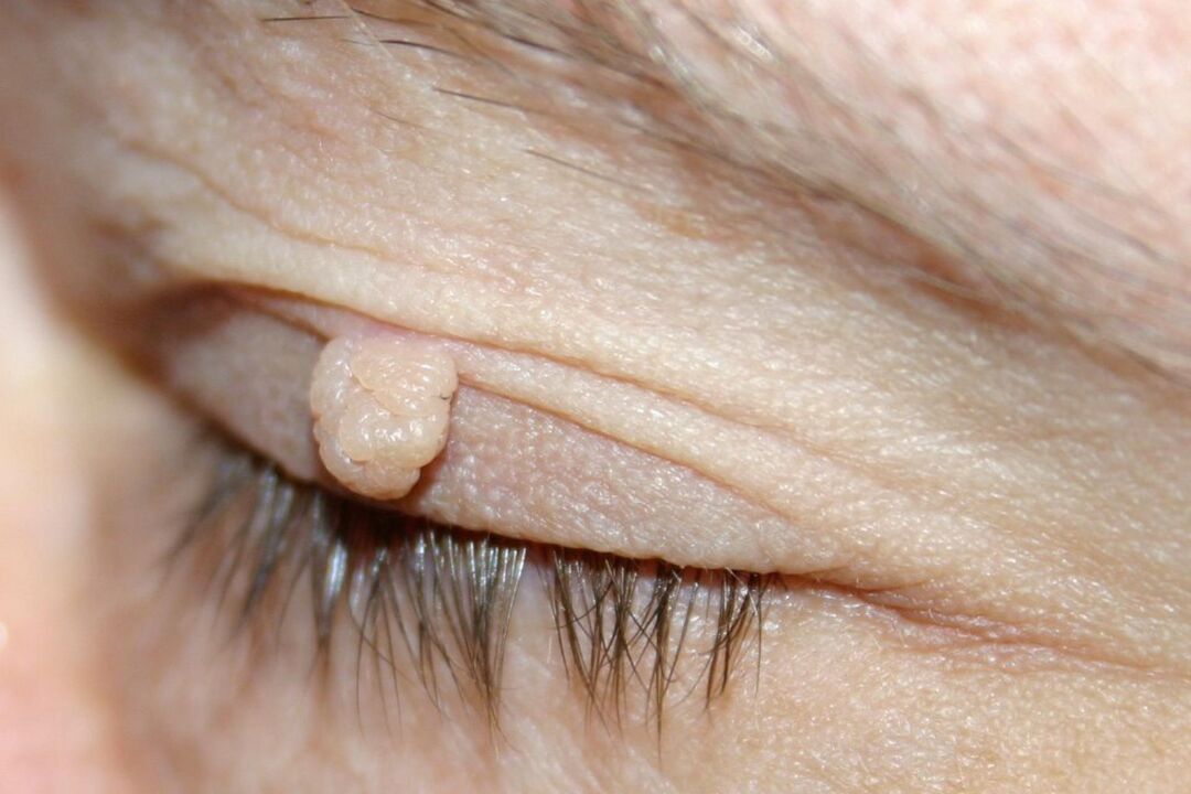 príznaky papilómu na očnom viečku