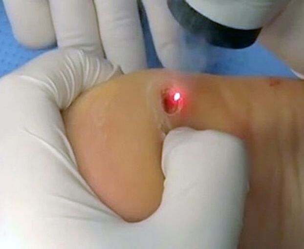 Postup na odstránenie bradavíc na päte pomocou lasera