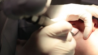 Laserové odstránenie papilómu na viečku